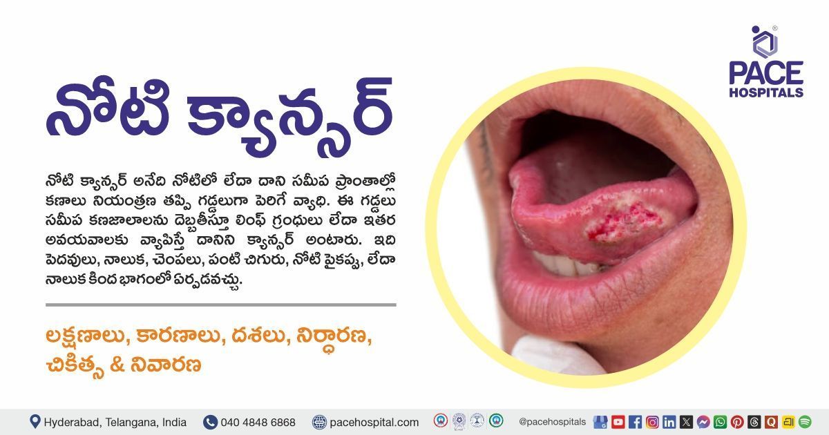 Mouth Cancer symptoms, causes, types, diagnosis & treatment in Telugu | Mouth Cancer in Telugu