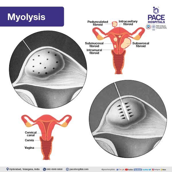 Myolysis in Hyderabad | Myolysis for Fibroids | Myolysis Fibroids Treatment