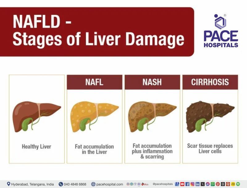 What is NASH What is NAFLD, What is NASH