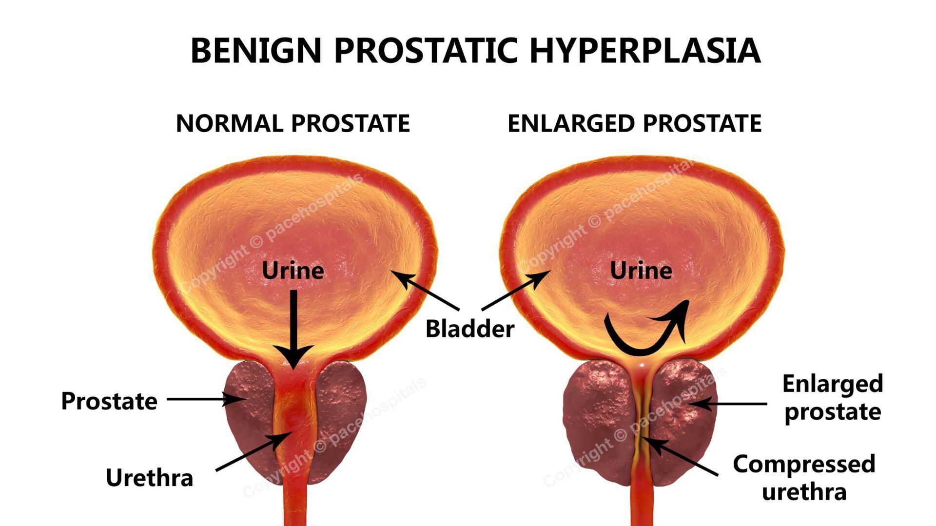 Normal and Enlarged Prostate (Benign prostatic hyperplasia)