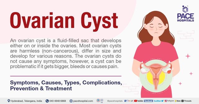 Ovarian cyst - Symptoms, Causes, Types, Complications & Treatment