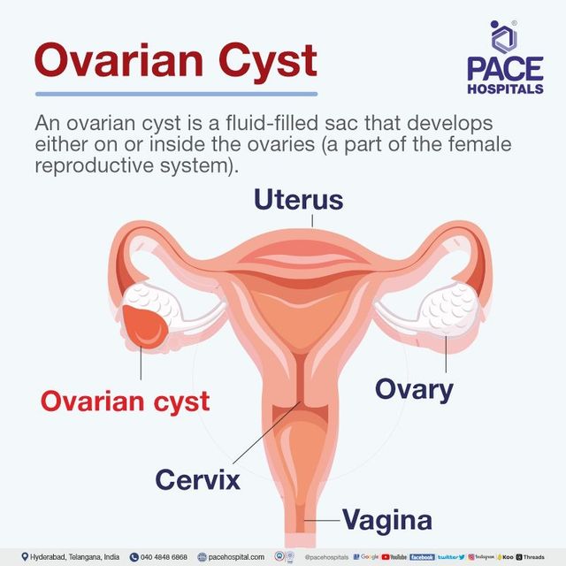 Ovarian Cyst, Symptoms & Treatments