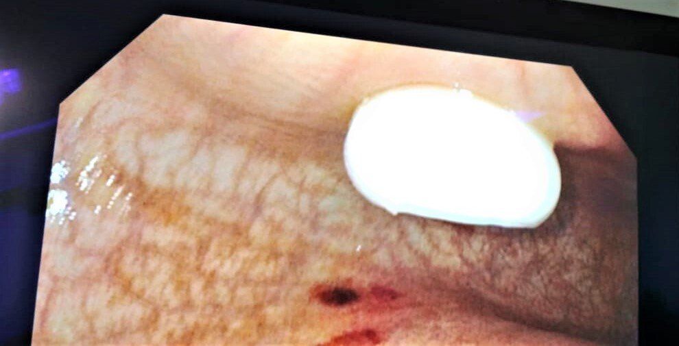 PEG tube for long term eneteral nutrition