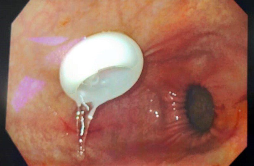 PEG tube for total dysphagia, Non-Hodgkins Lymphoma (NHL)