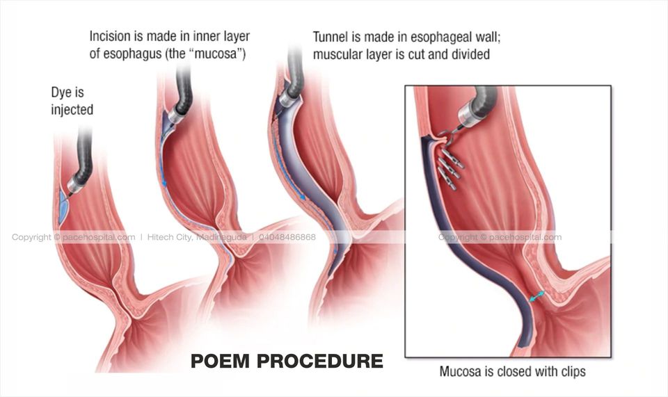 Peroral Endoscopic Myotomy (POEM) Procedure