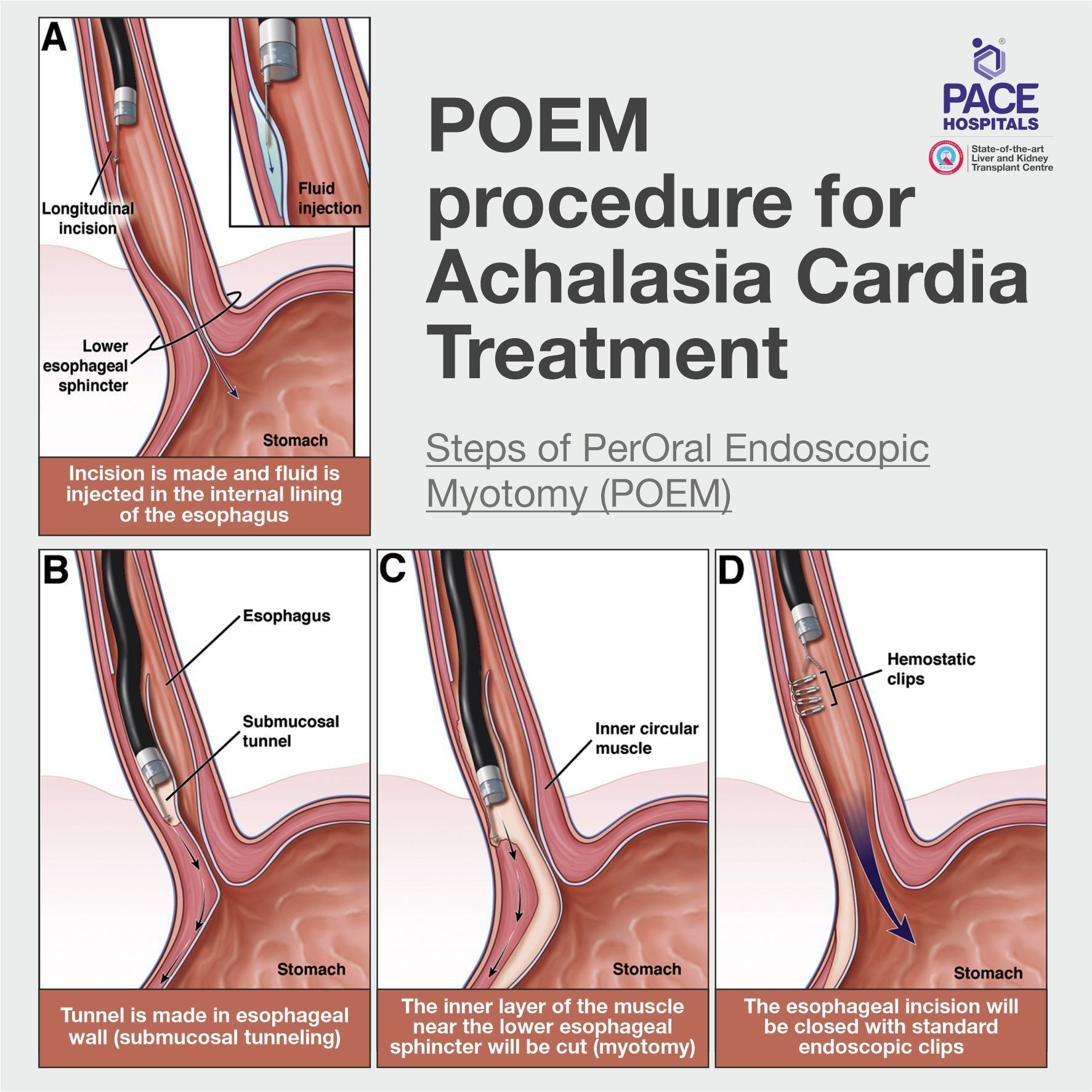 Peroral Endoscopic Myotomy - POEM for Achalasia Cardia Treatment in Hyderabad