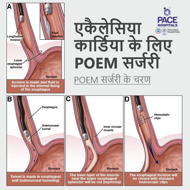 Peroral Endoscopic Myotomy in Hindi | POEM for Achalasia Cardia Treatment in Hyderabad