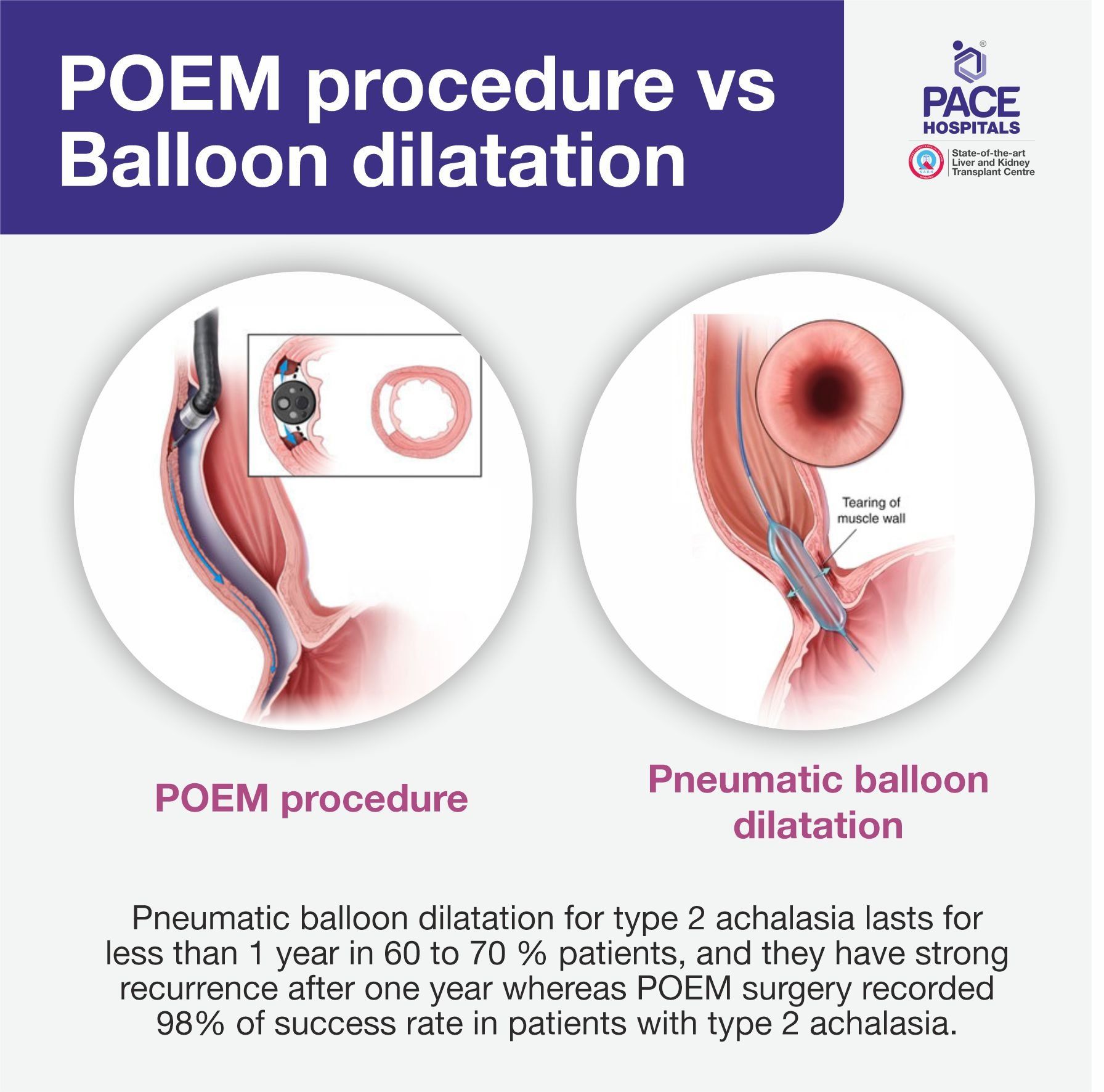 POEM vs balloon dilatation for type 2 achalasia