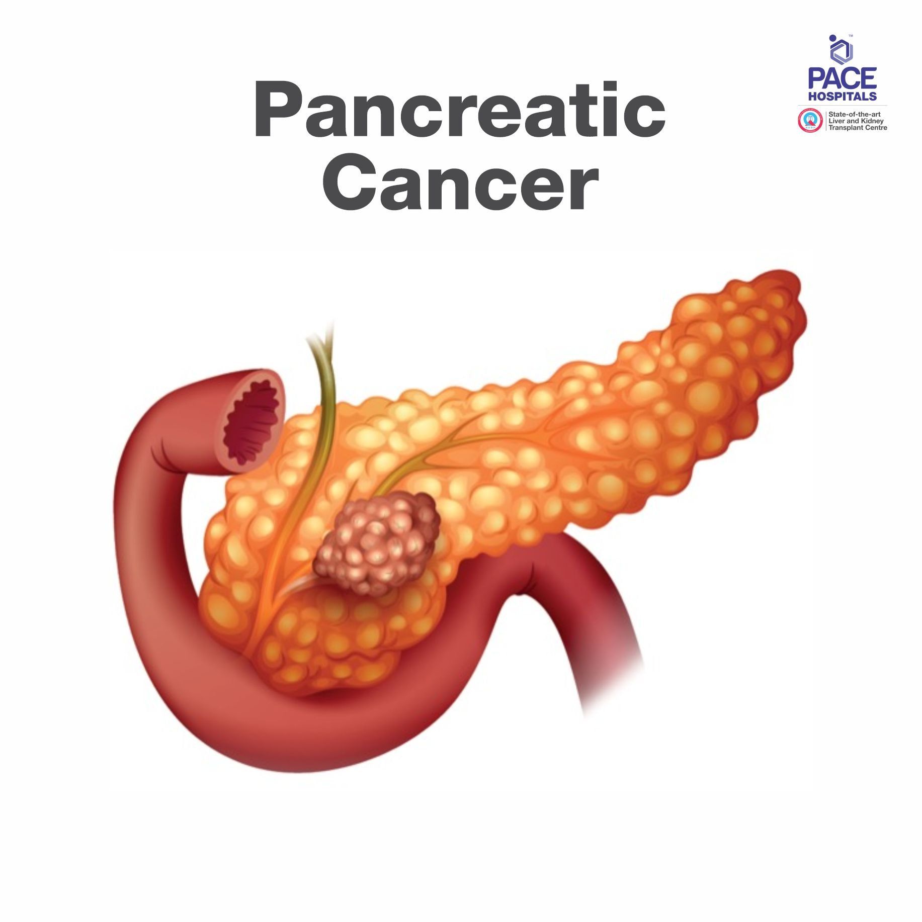 Best Hospital for Acute Pancreatitis & Chronic Pancreatitis Treatment