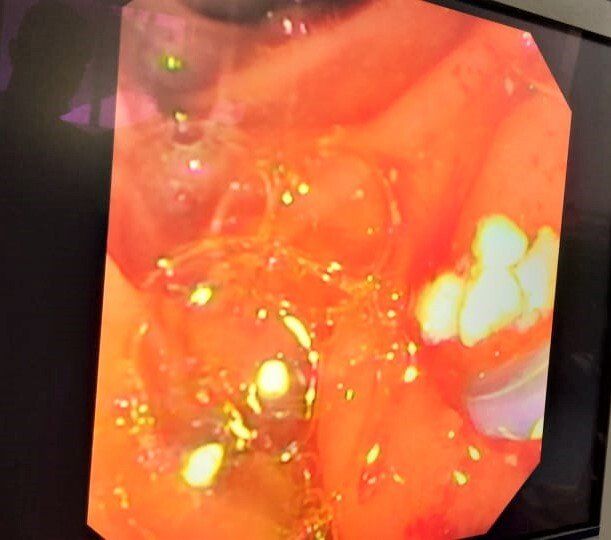 Pancreatic Stones - chronic pancreatitis patients