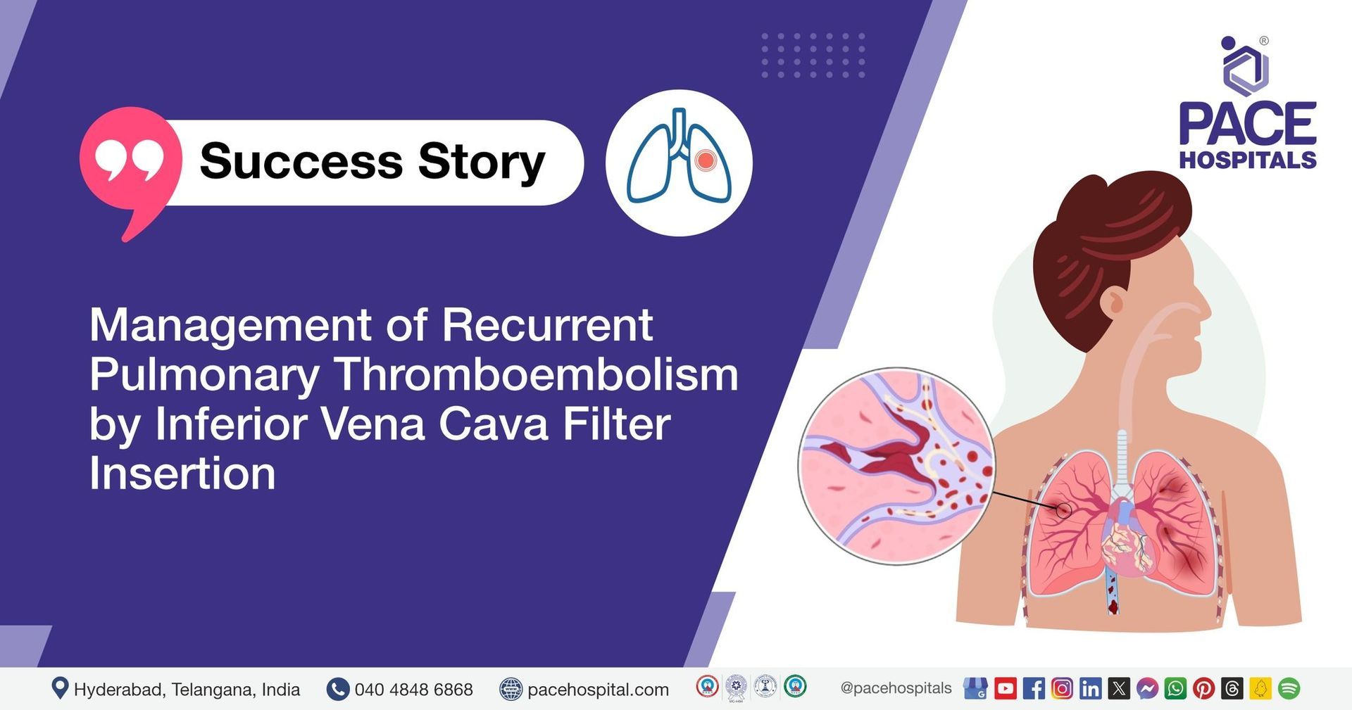 Case study of recurrent pulmonary thromboembolism treated with IVC filter insertion at PACE Hospital