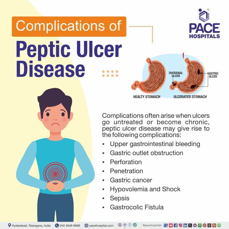 Complications of Peptic Ulcer Disease  | Most Common Complications of Peptic Ulcer Disease | Peptic Ulcer Disease Complications