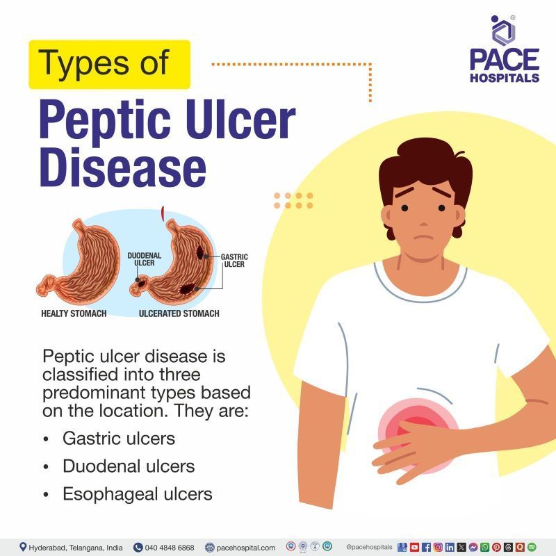 Types of Peptic Ulcer Disease Types | Peptic Ulcer Disease Types