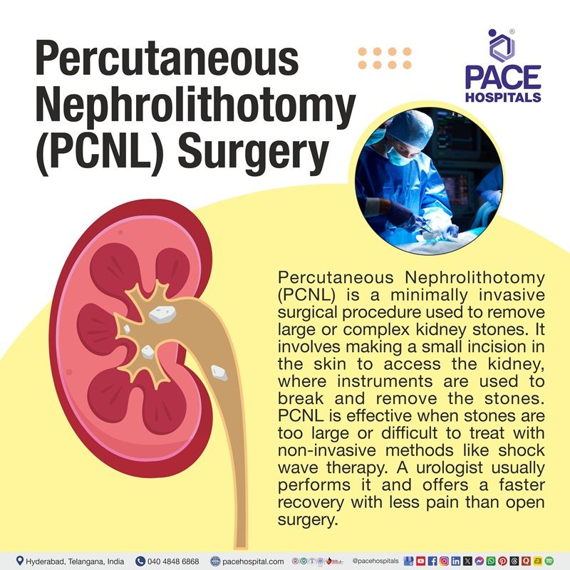 Best Hospital for PCNL Surgery in Hyderabad | High Success Rate