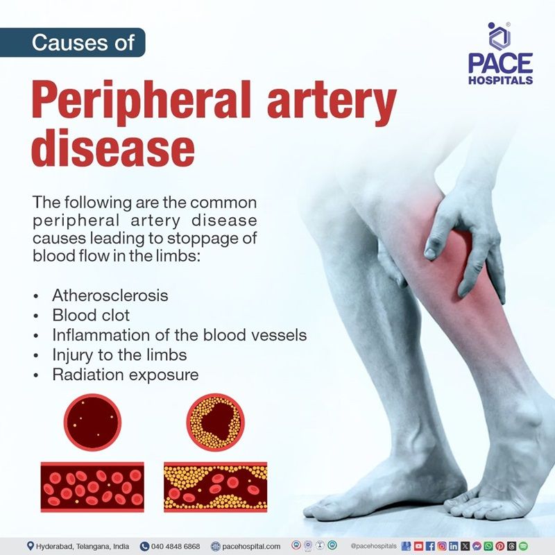 peripheral artery disease causes​ | main cause of peripheral artery disease​ | what causes peripheral artery disease​ | peripheral artery disease causes risk factors​ | Causes of peripheral artery disease