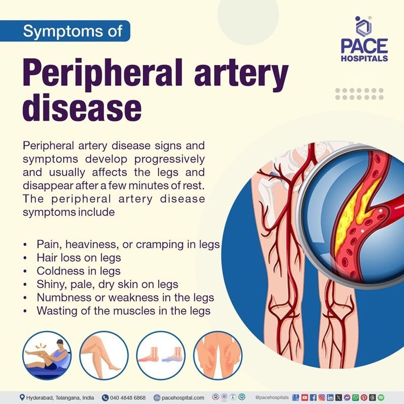 peripheral artery disease symptoms​ | peripheral artery disease pad symptoms​ | peripheral artery disease signs and symptoms​ | what is the most common symptom of peripheral artery disease​