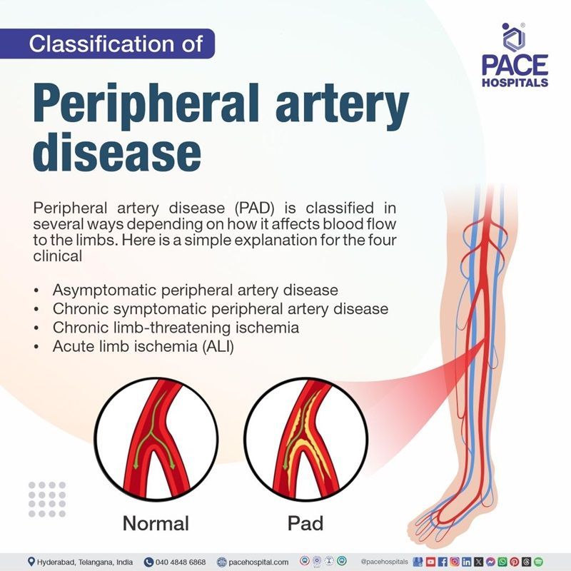 peripheral artery disease classification​
 | classification​ of peripheral artery disease | How peripheral artery disease is classified