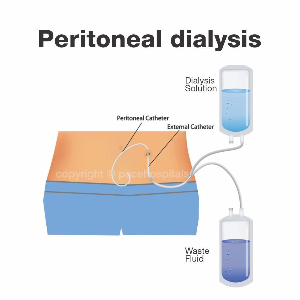 Peritoneal dialysis (PD) procedure | Best peritoneal dialysis centers in Hyderabad India | Pace Hospitals