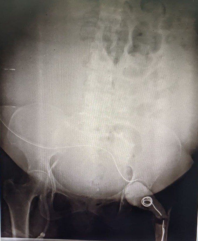 Peritoneal dialysis catheter insertion - autosomal dominant polycystic kidney disease