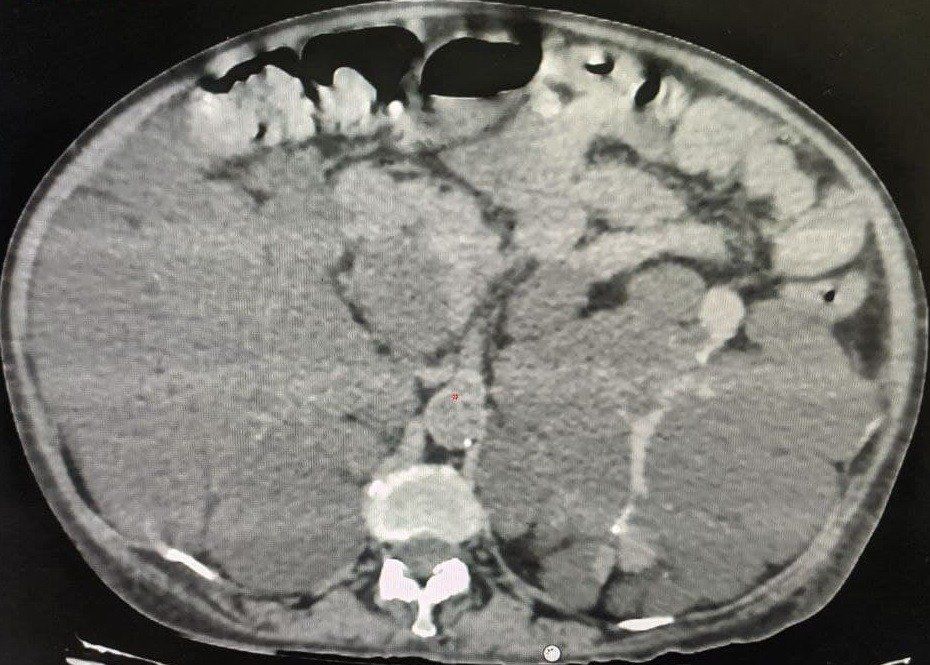 Peritoneal dialysis catheter insertion in patient with polycystic kidney disease