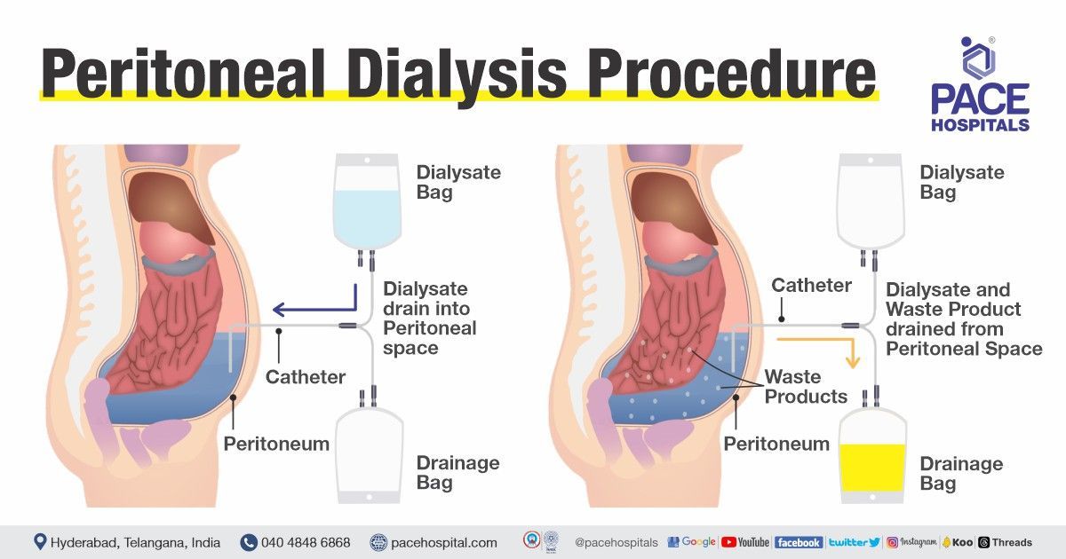 best peritoneal dialysis procedure in Hyderabad | pd dialysis centers | peritoneal dialysis cost in hyderabad India | Price or Cost of peritoneal dialysis procedure