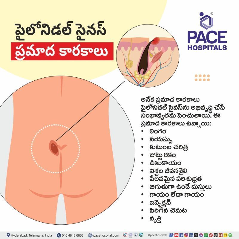 Pilonidal Sinus Risk factors in Telugu | పైలోనిడల్ సైనస్ ప్రమాద కారకాలు | Risk factors of Pilonidal Sinus in Telugu