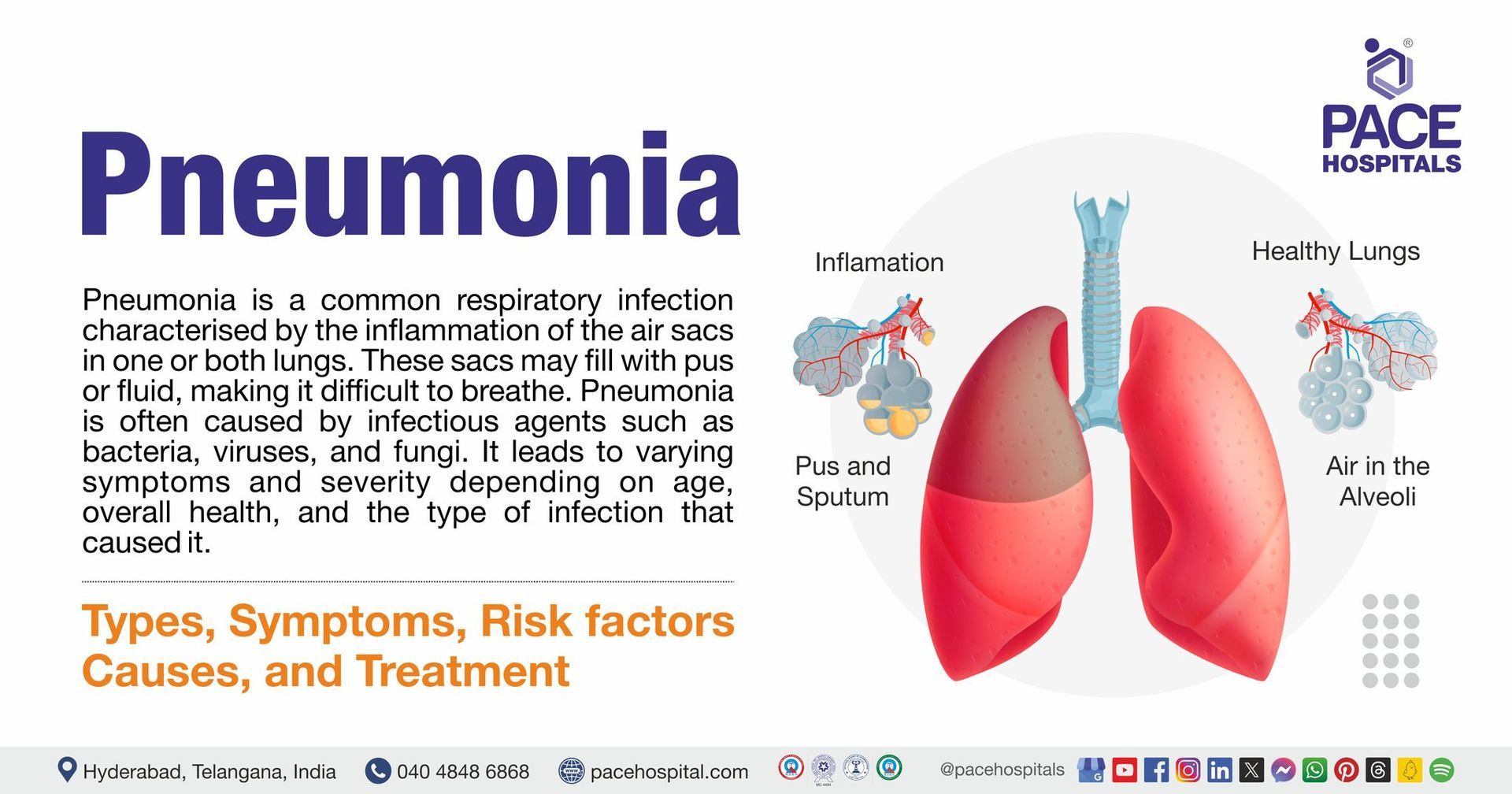 Pneumonia symptoms & Causes | Pneumonia treatment in India | bacterial pneumonia