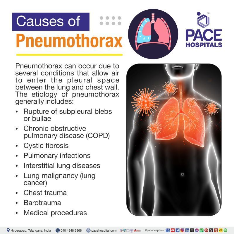 Pneumothorax Causes | cause pneumothorax | What causes pneumothorax​