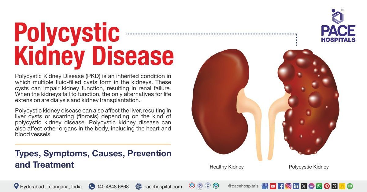 Polycystic kidney disease treatment in India | Polycystic kidney disease symptoms and causes