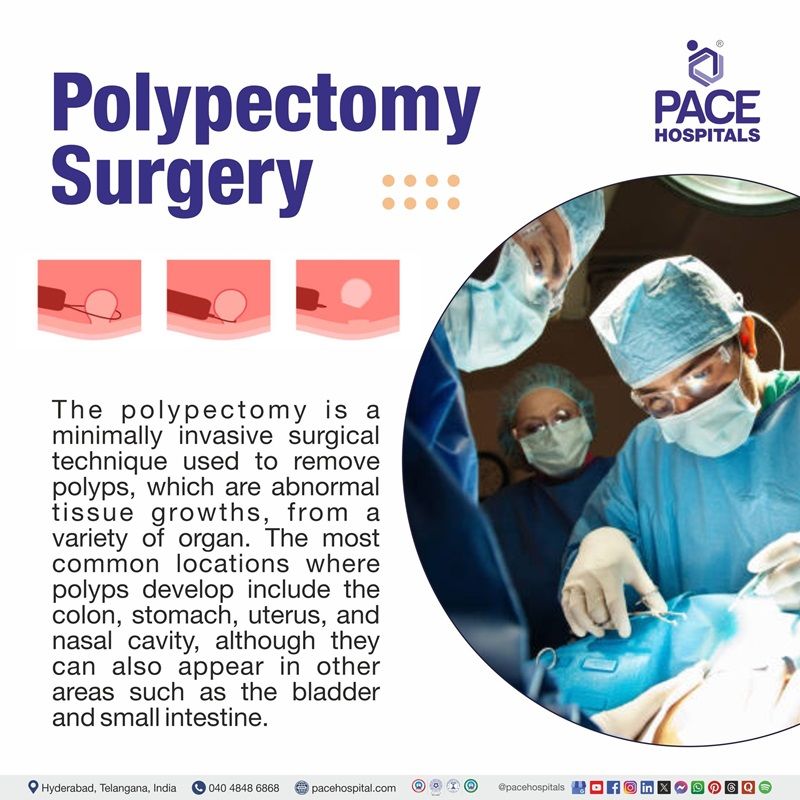 Best Polypectomy surgery hospital in Hyderabad | Best hospital for Polyps Removal Surgery in Hyderabad, India