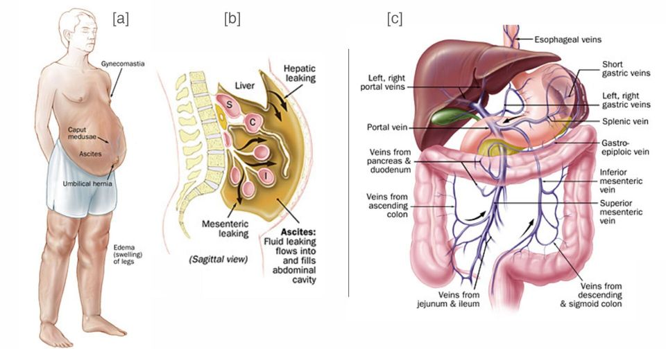 Portal Hypertension Anatomy and Ascites