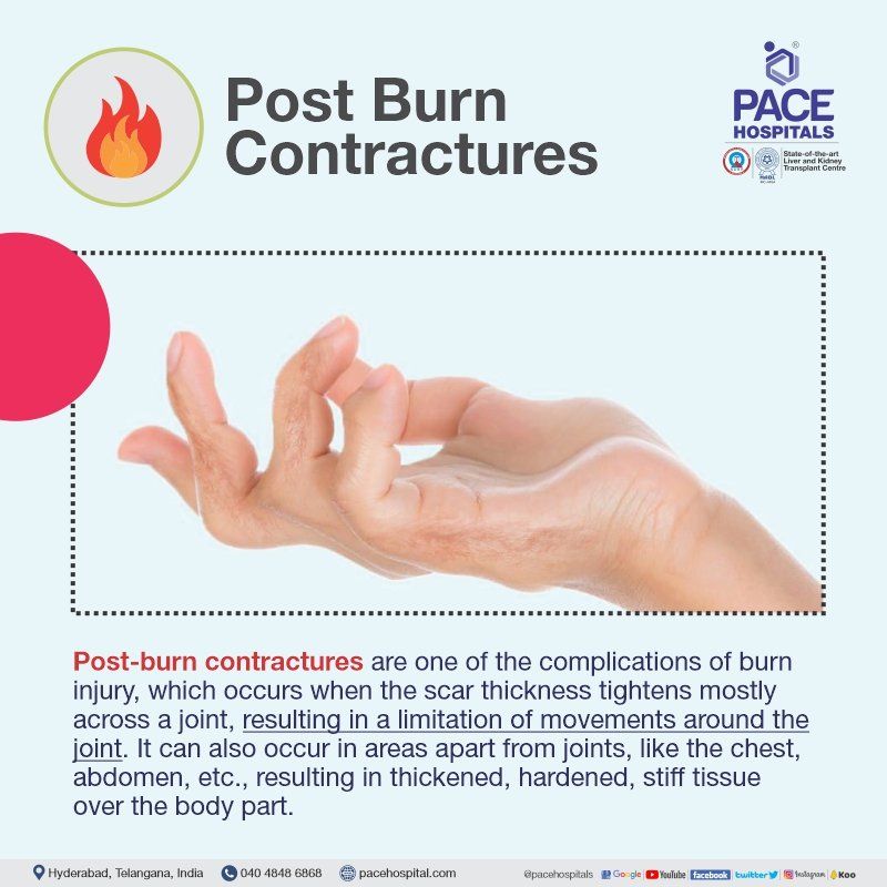 post burn contracture treatment in hyderabad | post burn contracture release surgery