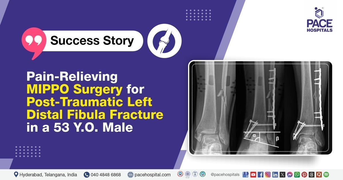 Case study of a 53-year-old male with a distal fibula fracture treated at PACE Hospitals, Hyderabad
