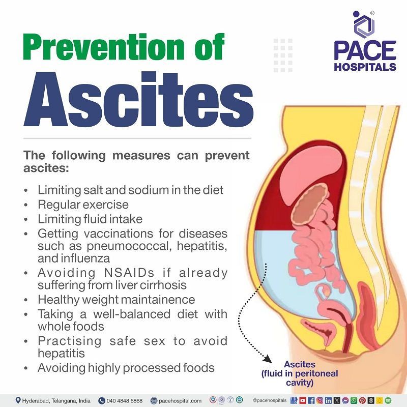 prevention of ascites | Ascites Preventive measures | Preventive measures of Ascites | Ascites Preventions | Preventions of Ascites | Visual narrating the Preventive measures of Ascites