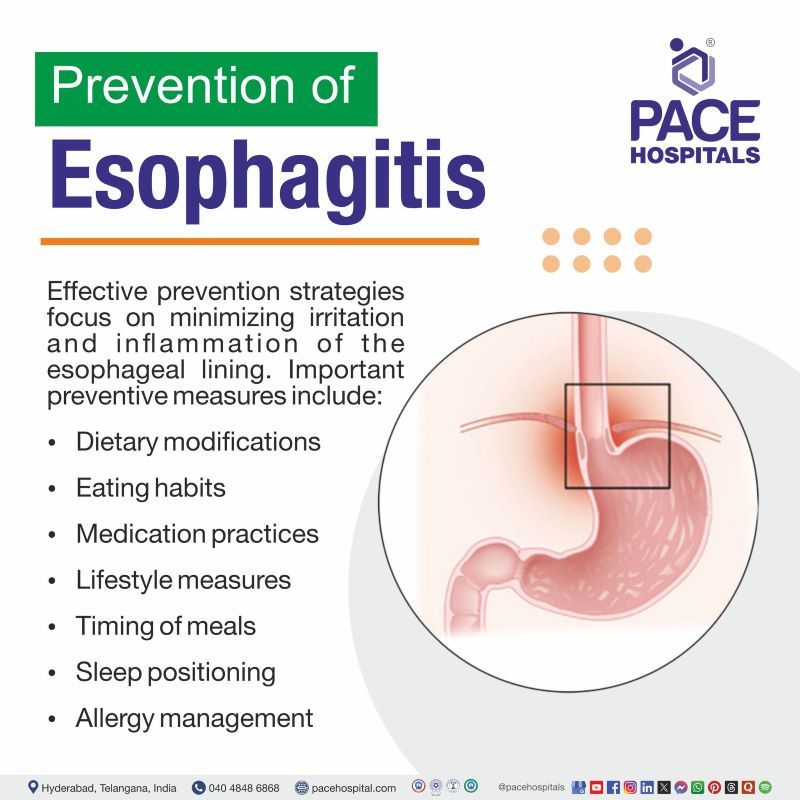Esophagitis Prevention | Prevention of Esophagitis