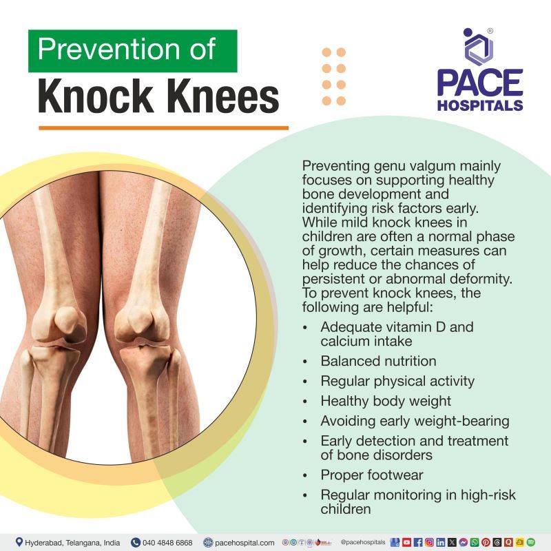 Prevention of knock knees | Genu Valgum prevention | How to prevent knock knees