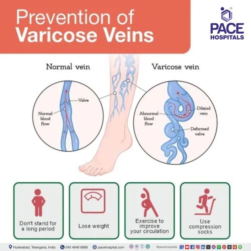 Varicose Veins Prevention how to prevent varicose veins | varicose veins prevention