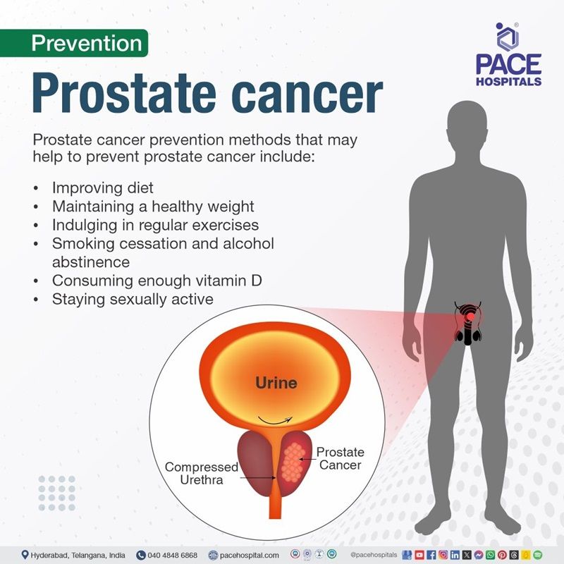 how to prevent prostate cancer​ | prostate cancer prevention​ | prostate gland cancer prevention​ | prevention of prostate cancer​