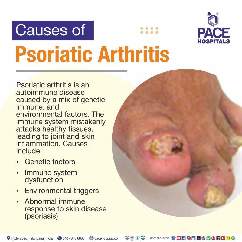 Psoriatic Arthritis Causes Psoriatic arthritis causes | Root cause of Psoriatic arthritis | What causes psoriatic arthritis | PsA causes