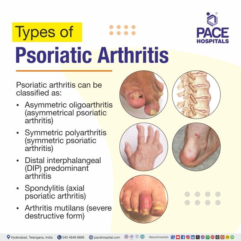 Psoriatic Arthritis Types What are the 5 types of psoriatic arthritis | Psoriatic arthritis types | 5 Types of psoriatic arthritis | Types of PsA