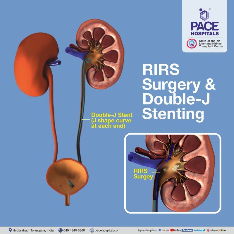 RIRS Surgery and Double- J stent, Retrograde Intrarenal Surgery with DJ stent
