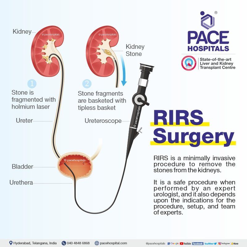 RIRS surgery for kidney stone treatment in  hyderabad, RIRS Procedure, Retrograde Intrarenal Surgery