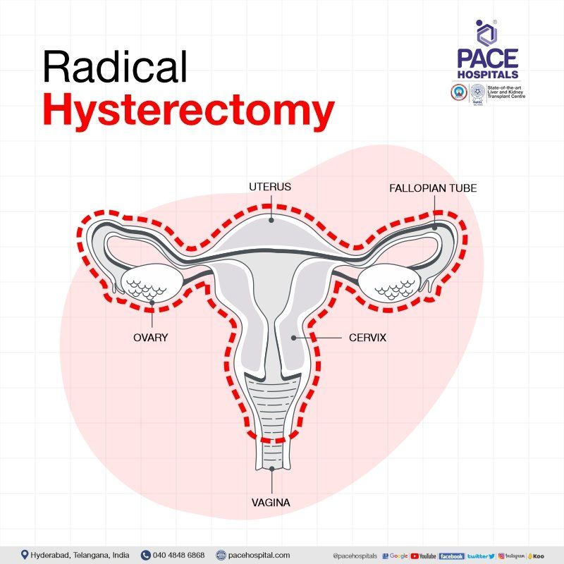 Radical hysterectomy in Hyderabad | Radical hysterectomy in India | Modified radical hysterectomy | Laparoscopic radical hysterectomy