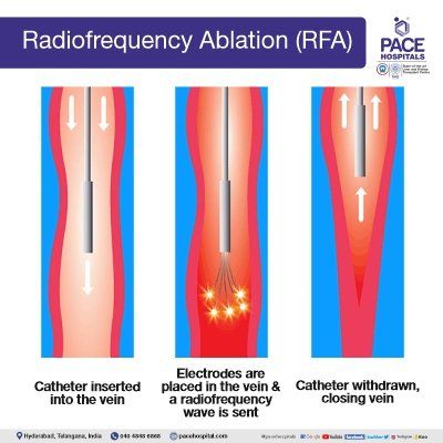 radiofrequency ablation in hyderabad | radiofrequency ablation for varicose veins