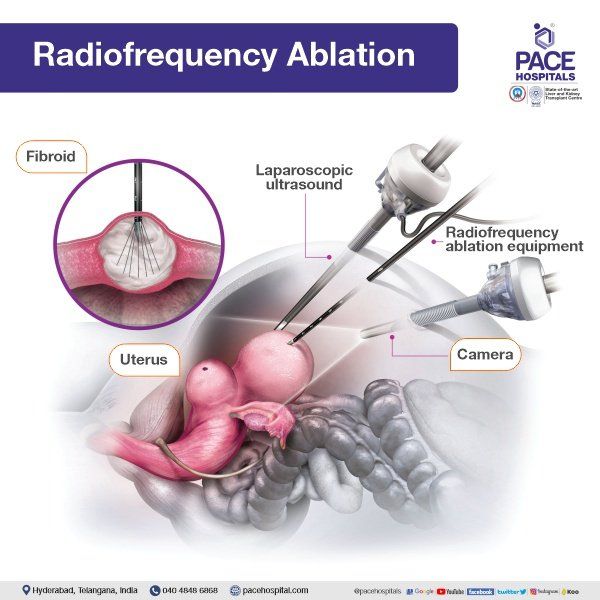 Radiofrequency Ablation in Hyderabad | Radiofrequency Ablation for Fibroids