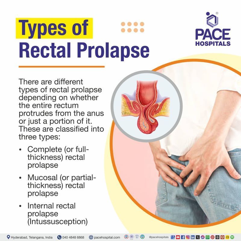 Rectal Prolapse Types Rectal Prolapse Types | Types of Rectal Prolapse | What are the types of Rectal Prolapse