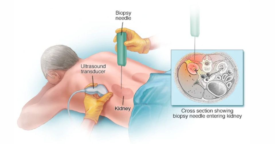 Kidney Biopsy : Indications, Preparation and Procedure