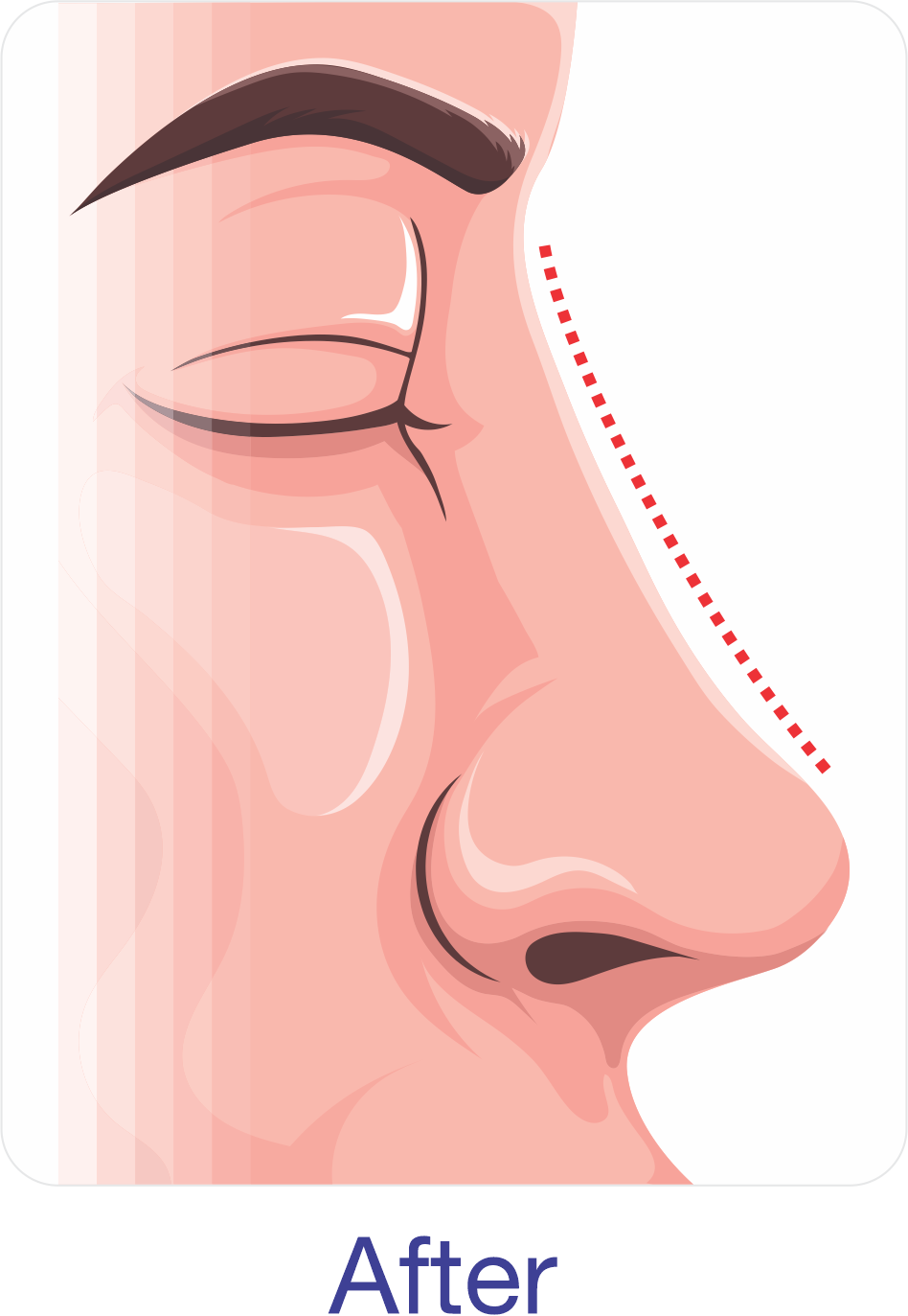 Rhinoplasty after​