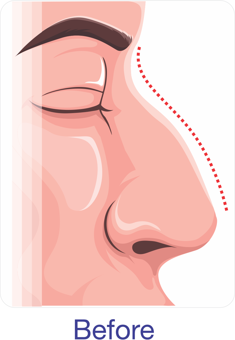 Rhinoplasty before