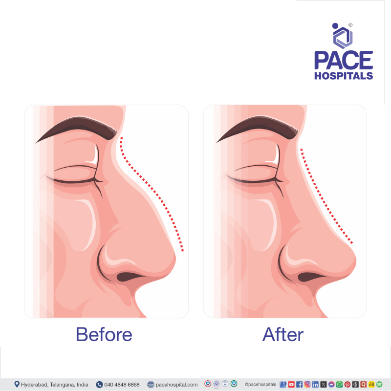 Visual depicting Rhinoplasty before and after | Nose job before and after